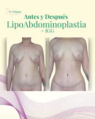 Abdominoplastia - Cirugía Plástica Dieppa