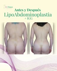Abdominoplastia - Cirugía Plástica Dieppa
