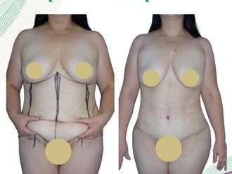 Abdominoplastía antes y después - 874730