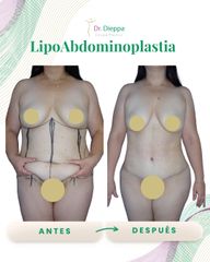 Lipo Abdominoplastia - Cirugía Plástica Dieppa