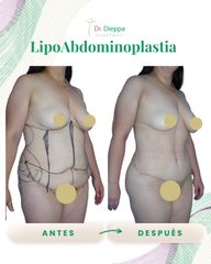 Lipo Abdominoplastia - Cirugía Plástica Dieppa
