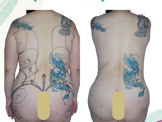 Abdominoplastía antes y después - 874732