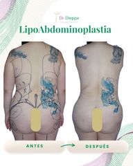 Lipo Abdominoplastia - Cirugía Plástica Dieppa