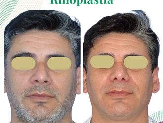 Rinoplastía antes y después - 874733