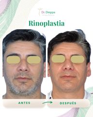 Rinoplastia - Cirugía Plástica Dieppa