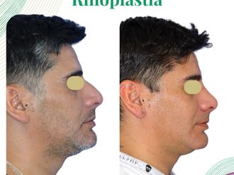 Rinoplastía antes y después - 874734