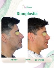 Rinoplastia -Cirugía Plástica Dieppa