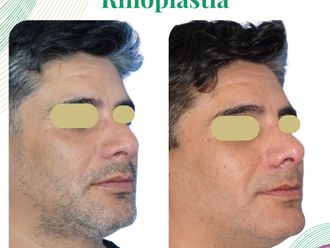 Rinoplastía antes y después - 874735
