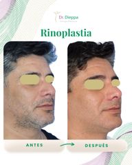 Rinoplastia - Cirugía Plástica Dieppa