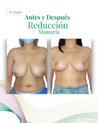 Reducción Mamaria - Cirugía Plástica Dieppa