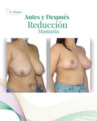 Reducción Mamaria - Cirugía Plástica Dieppa