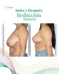 Reducción Mamaria - Cirugía Plástica Dieppa