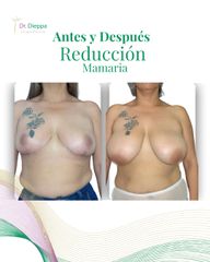 Reducción Mamaria - Cirugía Plástica Dieppa