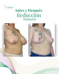 Reducción Mamaria - Cirugía Plástica Dieppa