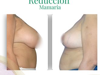 Reducción mamaria antes y después - 875435