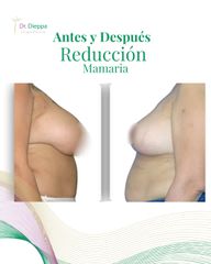 Reducción Mamaria -Cirugía Plástica Dieppa