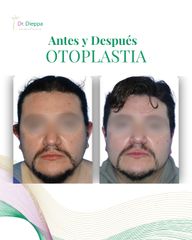 Otoplastia - Cirugía Plástica Dieppa