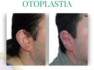 Otoplastia antes y después - 875833