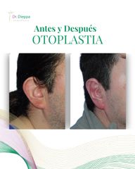 Otoplastia - Cirugía Plástica Dieppa