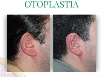 Otoplastia antes y después - 875834