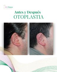 Otoplastia - Cirugía Plástica Dieppa