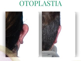 Otoplastia antes y después - 875835