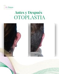 Otoplastia - Cirugía Plástica Dieppa