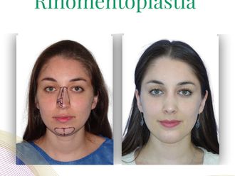 Rinoplastía antes y después - 875836