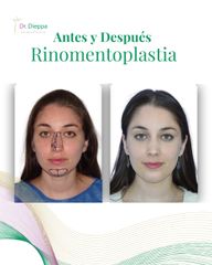 Rinomentoplastia -Cirugía Plástica Dieppa