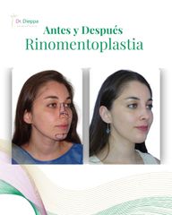 Rinomentoplastia - Cirugía Plástica Dieppa