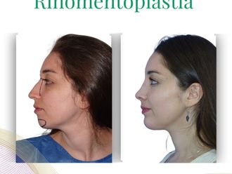 Otoplastia antes y después - 875838