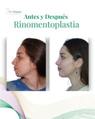 Rinomentoplastia - Cirugía Plástica Dieppa