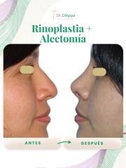 Rinoplastía - Cirugía Plástica Dieppa