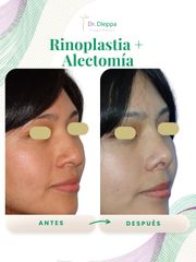 Rinoplastía - Cirugía Plástica Dieppa