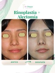 Rinoplastía - Cirugía Plástica Dieppa