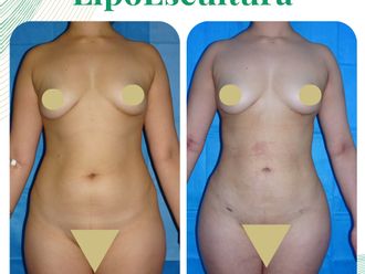 Lipoescultura antes y después - 876179