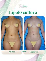 Lipoescultura - Cirugía Plástica Dieppa