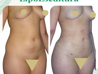 Lipoescultura antes y después - 876180