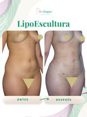 Lipoescultura - Cirugía Plástica Dieppa