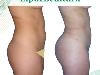 Lipoescultura antes y después - 876181