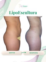 Lipoescultura - Cirugía Plástica Dieppa