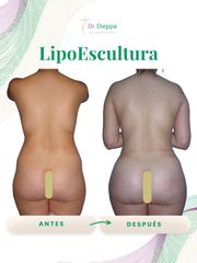 Lipoescultura - Cirugía Plástica Dieppa