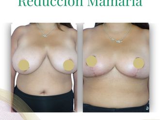 Reducción mamaria antes y después - 876607