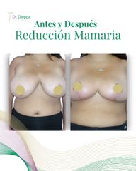 Reducción mamaria - Cirugía Plástica Dieppa