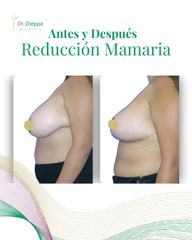 Reducción mamaria - Cirugía Plástica Dieppa