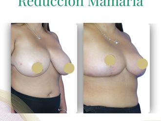 Reducción mamaria antes y después - 876609