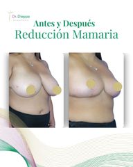 Reducción mamaria - Cirugía Plástica Dieppa