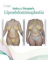 Lipoabdominoplastía - Cirugía Plástica Dieppa