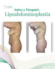Lipoabdominoplastía - Cirugía Plástica Dieppa
