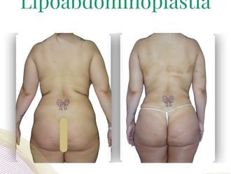 Abdominoplastía antes y después - 876612